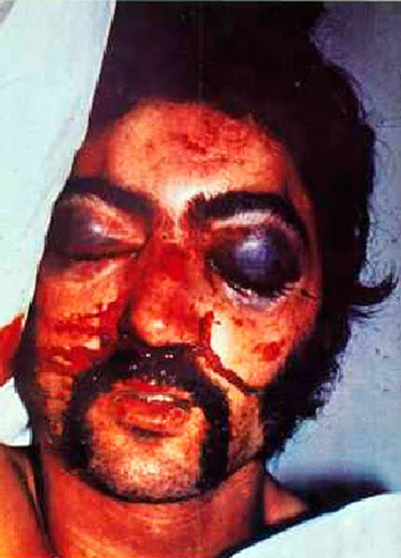 Eddie Carmichael, an Irish Republican prisoner beaten by British troops guarding the infamous Long Kesh concentration camp in October 1974