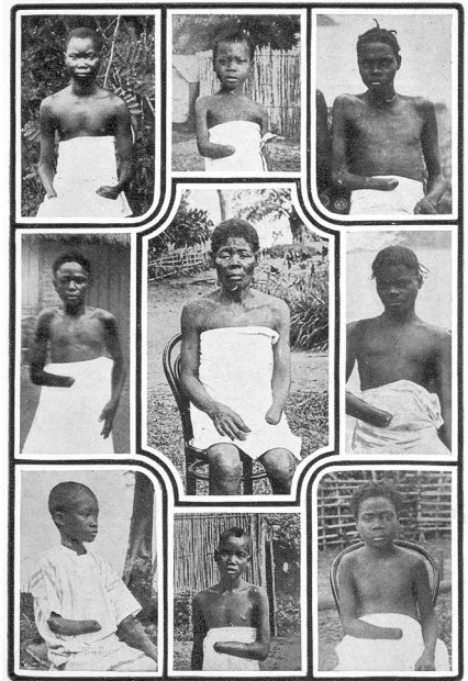 Native African workers in the Belgian Congo, men, women and children with their hands cut off by their European masters