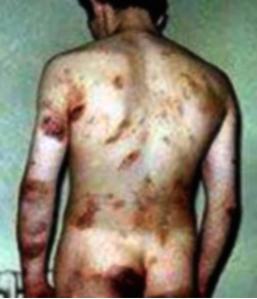 A contemporary medical photograph showing the injuries suffered by one of the Hooded Men, Irish civilian detainees tortured by the British Occupation Forces in Ireland, dating from the early 1970s